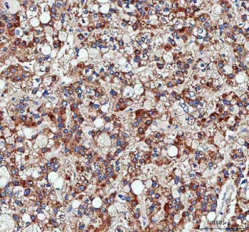 IHC staining of FFPE human liver cancer tissue with Pyruvate Carboxylase antibody. HIER: boil tissue sections in pH8 EDTA for 20 min and allow to cool before testing.