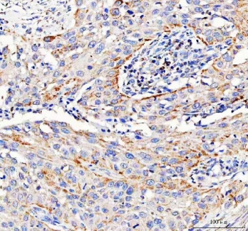 IHC staining of FFPE human bladder urothelial carcinoma tissue with Pyruvate Carboxylase antibody. HIER: boil tissue sections in pH8 EDTA for 20 min and allow to cool before testing.