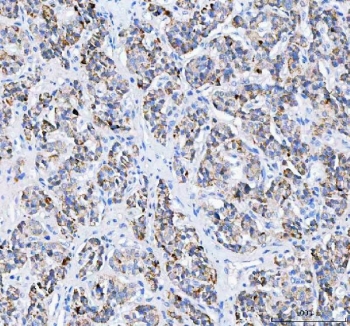 IHC staining of FFPE human lung adenocarcinoma tissue with Pyruvate Carboxylase antibody. HIER: boil tissue sections in pH8 EDTA for 20 min and allow to cool before testing.