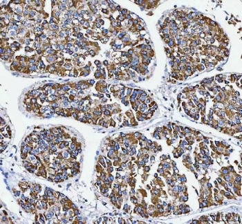 IHC staining of FFPE human liver cancer tissue with ATP5F1D antibody. HIER: boil tissue sections in pH8 EDTA for 20 min and allow to cool before testing.