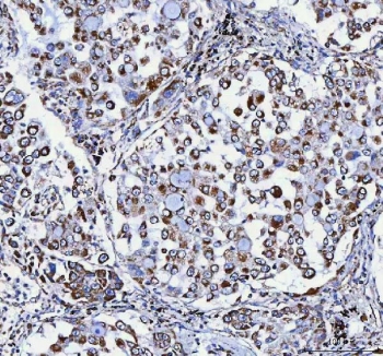 IHC staining of FFPE human lung cancer tissue with ATP5F1D antibody. HIER: boil tissue sections in pH8 EDTA for 20 min and allow to cool before testing.