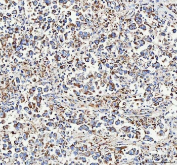 IHC staining of FFPE human testicular germ cell tumor tissue with ATP5F1D antibody. HIER: boil tissue sections in pH8 EDTA for 20 min and allow to cool before testing.