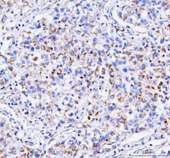 IHC staining of FFPE human lung cancer tissue with IDUA antibody. HIER: boil tissue sections in pH8 EDTA for 20 min and allow to cool before testing.