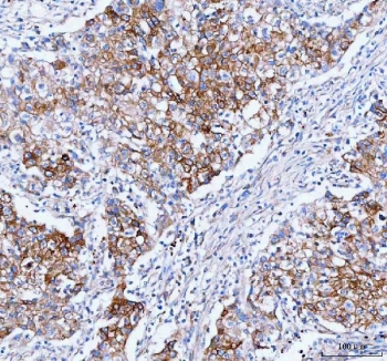IHC staining of FFPE human lung cancer tissue with IARS1 antibody. HIER: boil tissue sections in pH8 EDTA for 20 min and allow to cool before testing.