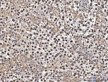 IHC staining of FFPE human testicular germ cell tumor tissue with Matrin 3 antibody. HIER: boil tissue sections in pH8 EDTA for 20 min and allow to cool before testing.