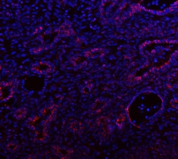 Immunofluorescent staining of FFPE human intestinal cancer tissue with IDH3A antibody (red) and DAPI nuclear stain (blue). HIER: steam section in pH8 EDTA buffer for 20 min.