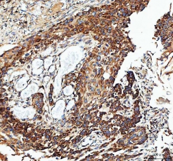 IHC staining of FFPE human esophageal squamous carcinoma tissue with IDH3G antibody. HIER: boil tissue sections in pH8 EDTA for 20 min and allow to cool before testing.