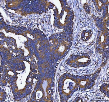 IHC staining of FFPE human colorectal adenocarcinoma tissue with DAPK1 antibody. HIER: boil tissue sections in pH8 EDTA for 20 min and allow to cool before testing.