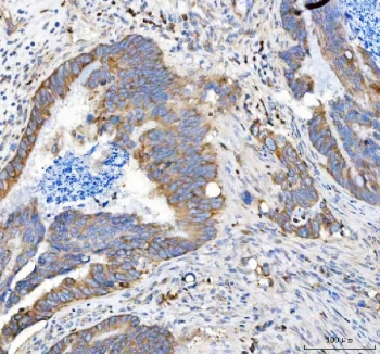 IHC staining of FFPE human colorectal adenocarcinoma tissue with Amyloid-like protein 2 antibody. HIER: boil tissue sections in pH8 EDTA for 20 min and allow to cool before testing.