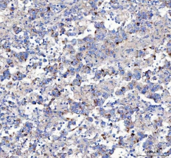 IHC staining of FFPE human testicular germ cell tumor tissue with Amyloid-like protein 2 antibody. HIER: boil tissue sections in pH8 EDTA for 20 min and allow to cool before testing.