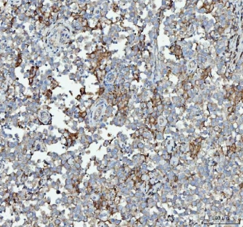 IHC staining of FFPE human testicular germ cell tumor tissue with RPL18 antibody. HIER: boil tissue sections in pH8 EDTA for 20 min and allow to cool before testing.