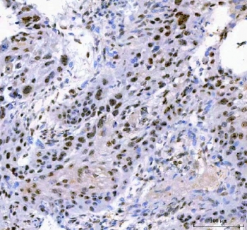 IHC staining of FFPE human esophageal squamous carcinoma tissue with IFFO1 antibody. HIER: boil tissue sections in pH8 EDTA for 20 min and allow to cool before testing.