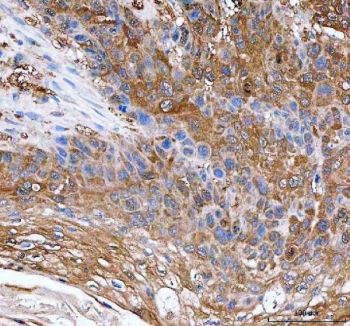 IHC staining of FFPE human esophageal squamous carcinoma tissue with IDI1 antibody. HIER: boil tissue sections in pH8 EDTA for 20 min and allow to cool before testing.