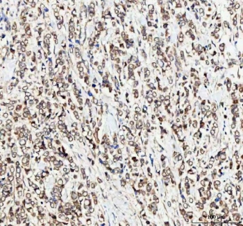 IHC staining of FFPE human breast cancer tissue with MTF1 antibody. HIER: boil tissue sections in pH8 EDTA for 20 min and allow to cool before testing.