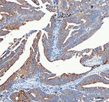 IHC staining of FFPE human rectum adenocarcinoma tissue with Mitofilin antibody. HIER: boil tissue sections in pH8 EDTA for 20 min and allow to cool before testing.