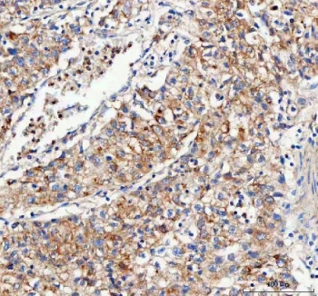 IHC staining of FFPE human lung cancer tissue with Mitofilin antibody. HIER: boil tissue sections in pH8 EDTA for 20 min and allow to cool before testing.