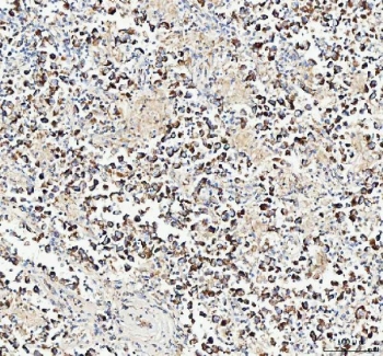 IHC staining of FFPE human testicular germ cell tumor tissue with Mitofilin antibody. HIER: boil tissue sections in pH8 EDTA for 20 min and allow to cool before testing.