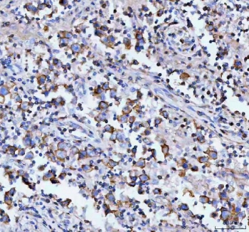 IHC staining of FFPE human testicular germ cell tumor tissue with MOGAT2 antibody. HIER: boil tissue sections in pH8 EDTA for 20 min and allow to cool before testing.