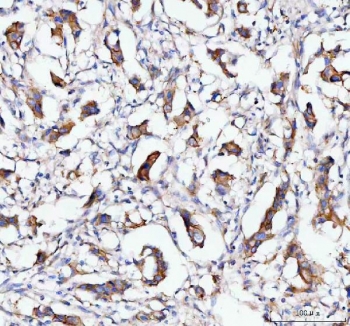 IHC staining of FFPE human breast cancer tissue with MOGAT2 antibody. HIER: boil tissue sections in pH8 EDTA for 20 min and allow to cool before testing.