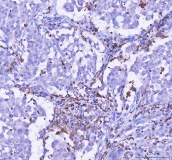 IHC staining of FFPE human lung cancer tissue with LPCAT2 antibody. HIER: boil tissue sections in pH8 EDTA for 20 min and allow to cool before testing.