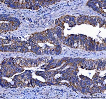 IHC staining of FFPE human colorectal adenocarcinoma tissue with LGI4 antibody. HIER: boil tissue sections in pH8 EDTA for 20 min and allow to cool before testing.