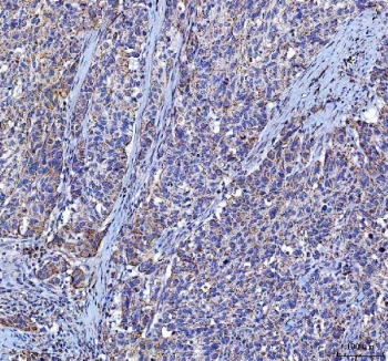 IHC staining of FFPE human bladder urothelial carcinoma tissue with LGI4 antibody. HIER: boil tissue sections in pH8 EDTA for 20 min and allow to cool before testing.