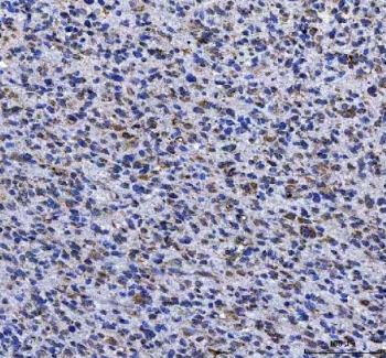 IHC staining of FFPE human glioma tissue with LGI4 antibody. HIER: boil tissue sections in pH8 EDTA for 20 min and allow to cool before testing.