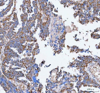 IHC staining of FFPE human ovarian serous adenocarcinoma tissue with Pellino-3 antibody. HIER: boil tissue sections in pH8 EDTA for 20 min and allow to cool before testing.