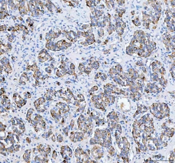 IHC staining of FFPE human lung adenocarcinoma tissue with Pellino-3 antibody. HIER: boil tissue sections in pH8 EDTA for 20 min and allow to cool before testing.