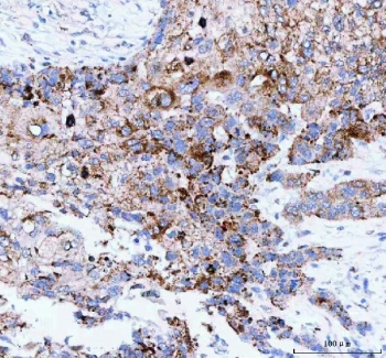 IHC staining of FFPE human esophageal squamous carcinoma tissue with Josephin 2 antibody. HIER: boil tissue sections in pH8 EDTA for 20 min and allow to cool before testing.