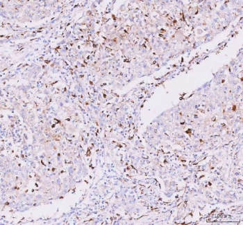 IHC staining of FFPE human lung cancer tissue with Josephin 2 antibody. HIER: boil tissue sections in pH8 EDTA for 20 min and allow to cool before testing.