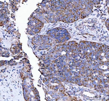 LRRN4 Antibody Ovarian Carcinoma IHC. Immunohistochemistry staining of FFPE human ovarian carcinoma tissue with LRRN4 Antibody / Cancer-Associated LRR Protein Antibody demonstrates diffuse cytoplasmic and membranous HRP-DAB brown staining in malignant epithelial cells, consistent with carcinoma-associated expression of Leucine rich repeat neuronal protein 4 / LRRN4 in ovarian tumor tissue. HIER: boil tissue sections in pH8 EDTA for 20 min and allow to cool before testing.
