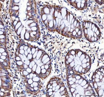 LRRN4 Antibody Colorectal Adenocarcinoma IHC. Immunohistochemistry staining of FFPE human colorectal adenocarcinoma tissue with LRRN4 Antibody / Cancer-Associated LRR Protein Antibody demonstrates predominantly apical and cytoplasmic HRP-DAB brown staining in malignant gland-forming epithelial cells, supporting expression of Leucine rich repeat neuronal protein 4 / LRRN4 in gastrointestinal carcinoma-associated cellular populations. HIER: boil tissue sections in pH8 EDTA for 20 min and allow to cool before testing.
