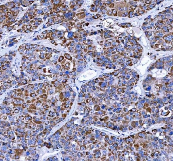 LRRN4 Antibody Liver Cancer IHC. Immunohistochemistry staining of FFPE human liver cancer tissue with LRRN4 Antibody / Cancer-Associated LRR Protein Antibody demonstrates diffuse cytoplasmic HRP-DAB brown staining in malignant hepatic tumor cells with focal membranous accentuation, consistent with carcinoma-associated expression of Leucine rich repeat neuronal protein 4 / LRRN4 in liver malignancy tissue. HIER: boil tissue sections in pH8 EDTA for 20 min and allow to cool before testing.