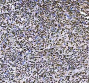 IHC staining of FFPE human cervical squamous carcinoma tissue with LEO1 antibody. HIER: boil tissue sections in pH8 EDTA for 20 min and allow to cool before testing.
