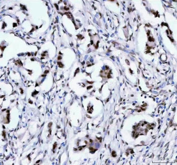 IHC staining of FFPE human breast cancer tissue with LEO1 antibody. HIER: boil tissue sections in pH8 EDTA for 20 min and allow to cool before testing.