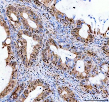 IHC staining of FFPE human ovarian serous adenocarcinoma tissue with LEO1 antibody. HIER: boil tissue sections in pH8 EDTA for 20 min and allow to cool before testing.