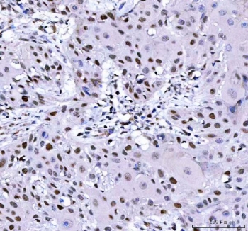 IHC staining of FFPE human esophageal squamous carcinoma tissue with L3MBTL2 antibody. HIER: boil tissue sections in pH8 EDTA for 20 min and allow to cool before testing.