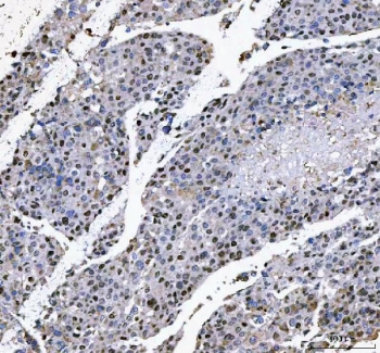 IHC staining of FFPE human liver cancer tissue with L3MBTL2 antibody. HIER: boil tissue sections in pH8 EDTA for 20 min and allow to cool before testing.