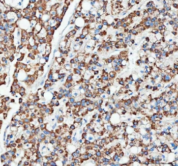 IHC staining of FFPE human liver cancer tissue with OTUB1 antibody. HIER: boil tissue sections in pH8 EDTA for 20 min and allow to cool before testing.