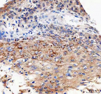 IHC staining of FFPE human esophageal squamous carcinoma tissue with CMG-1 antibody. HIER: boil tissue sections in pH8 EDTA for 20 min and allow to cool before testing.