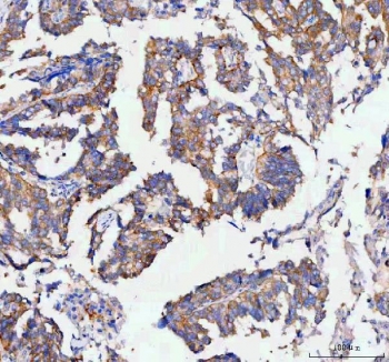 IHC staining of FFPE human ovarian serous adenocarcinoma tissue with RAB3IP antibody. HIER: boil tissue sections in pH8 EDTA for 20 min and allow to cool before testing.