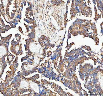 IHC staining of FFPE human ovarian serous adenocarcinoma tissue with PAIP1 antibody. HIER: boil tissue sections in pH8 EDTA for 20 min and allow to cool before testing.