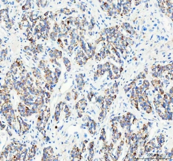 IHC staining of FFPE human lung adenocarcinoma tissue with Pellino 2 antibody. HIER: boil tissue sections in pH8 EDTA for 20 min and allow to cool before testing.