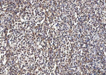IHC staining of FFPE human intestinal diffuse large B-cell lymphoma tissue with MCCC2 antibody. HIER: boil tissue sections in pH8 EDTA for 20 min and allow to cool before testing.