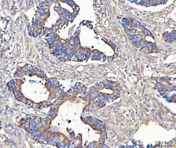 IHC staining of FFPE human rectum adenocarcinoma tissue with MCCC2 antibody. HIER: boil tissue sections in pH8 EDTA for 20 min and allow to cool before testing.
