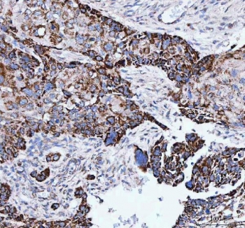 IHC staining of FFPE human esophageal squamous carcinoma tissue with IARS2 antibody. HIER: boil tissue sections in pH8 EDTA for 20 min and allow to cool before testing.
