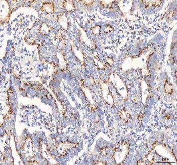 IHC staining of FFPE human colon adenocarcinoma tissue with BPNT2 antibody. HIER: boil tissue sections in pH8 EDTA for 20 min and allow to cool before testing.