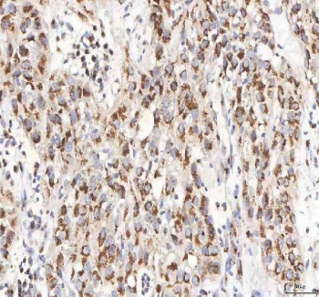 IHC staining of FFPE human urothelial carcinoma tissue with BPNT2 antibody. HIER: boil tissue sections in pH8 EDTA for 20 min and allow to cool before testing.