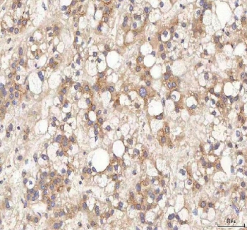 IHC staining of FFPE human liver cancer tissue with BPNT2 antibody. HIER: boil tissue sections in pH8 EDTA for 20 min and allow to cool before testing.